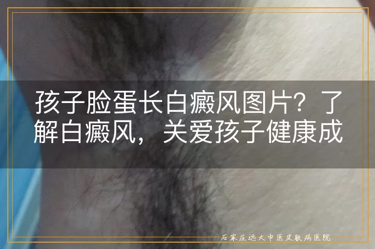 孩子脸蛋长白癜风图片？了解白癜风，关爱孩子健康成长！