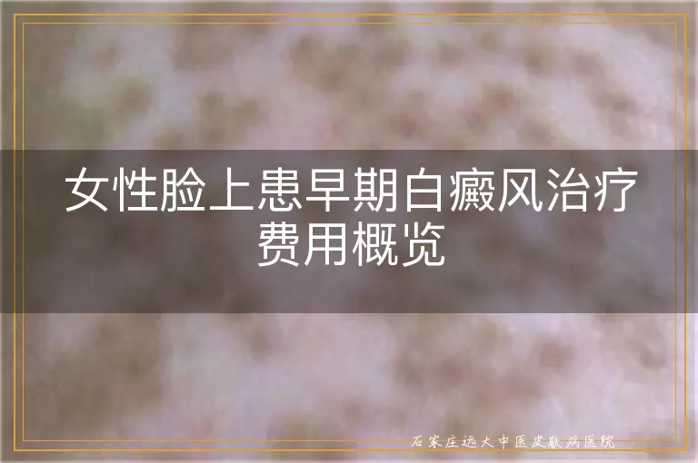 女性脸上患早期白癜风治疗费用概览
