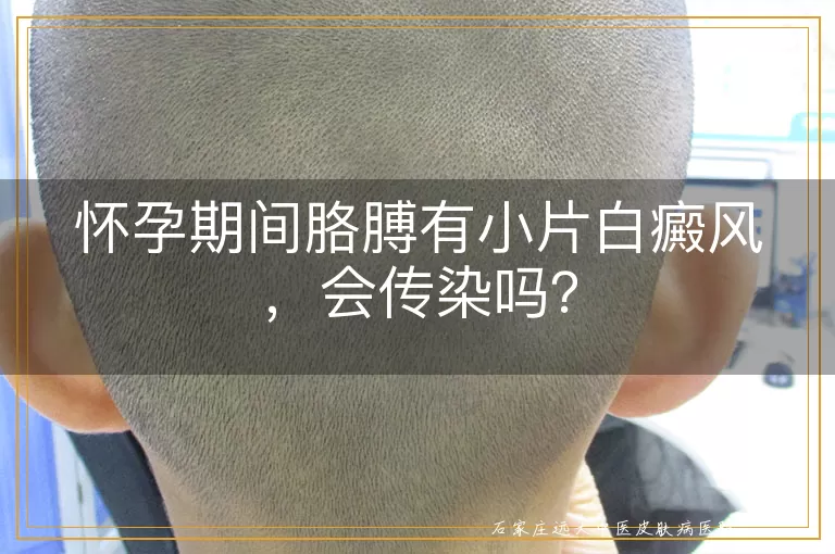 怀孕期间胳膊有小片白癜风，会传染吗？