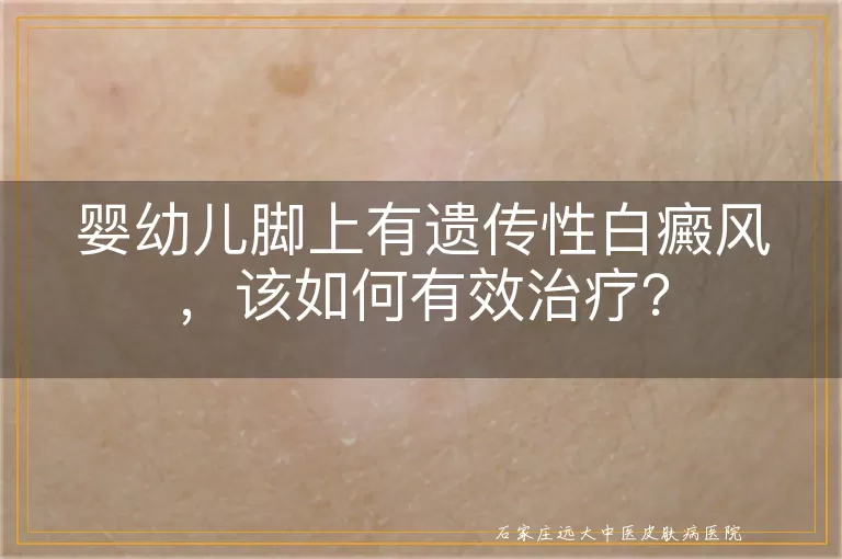 婴幼儿脚上有遗传性白癜风，该如何有效治疗？