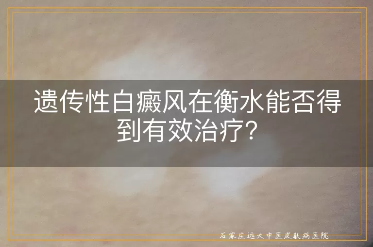 遗传性白癜风在衡水能否得到有效治疗？