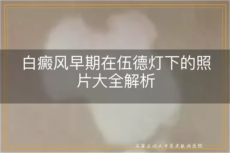 白癜风早期在伍德灯下的照片大全解析