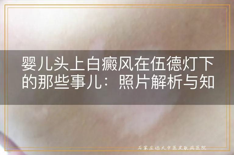 婴儿头上白癜风在伍德灯下的那些事儿：照片解析与知识分享