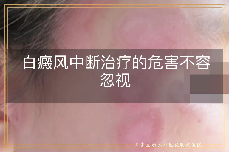 白癜风中断治疗的危害不容忽视