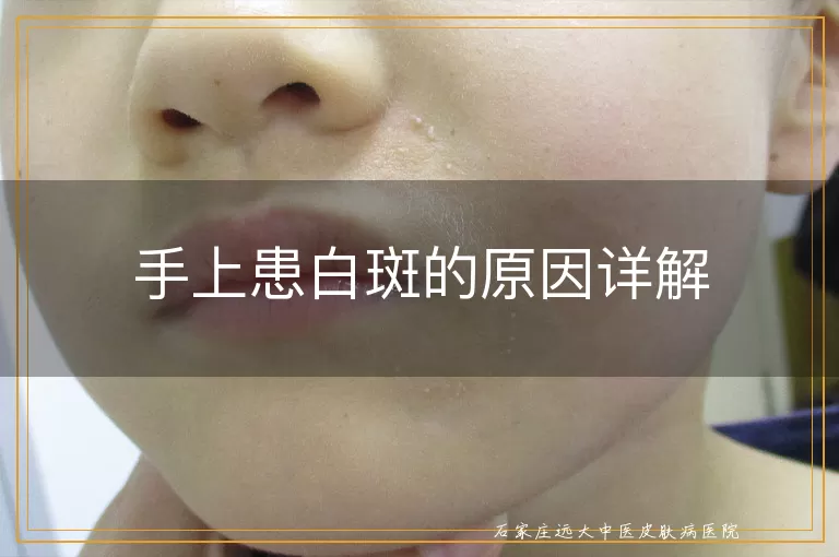 手上患白斑的原因详解