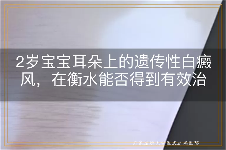 2岁宝宝耳朵上的遗传性白癜风，在衡水能否得到有效治疗？