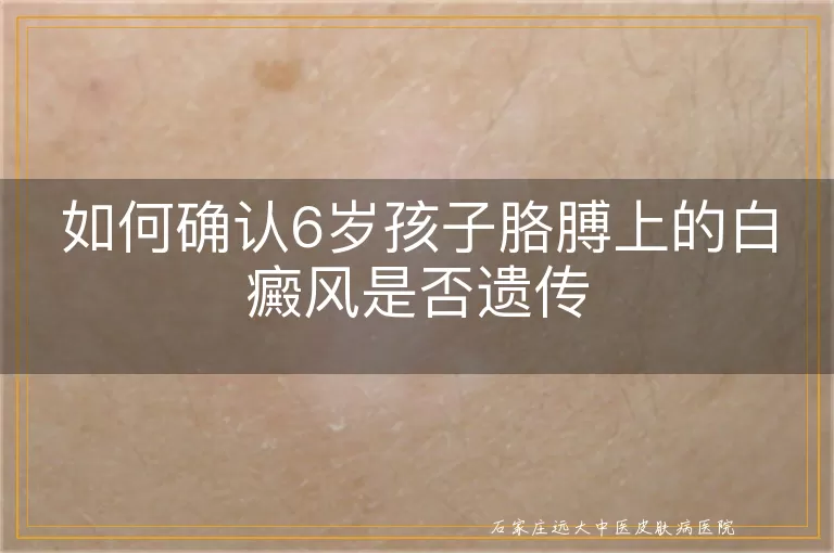 如何确认6岁孩子胳膊上的白癜风是否遗传