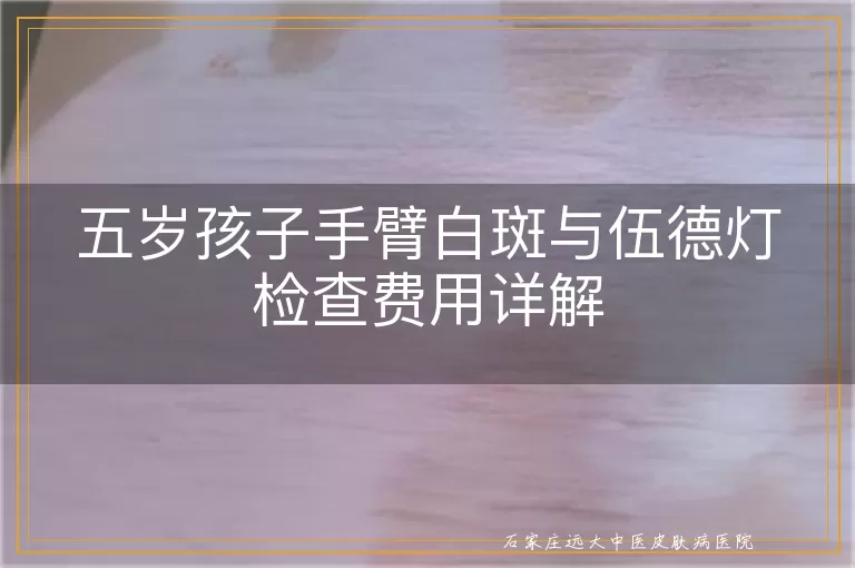 五岁孩子手臂白斑与伍德灯检查费用详解
