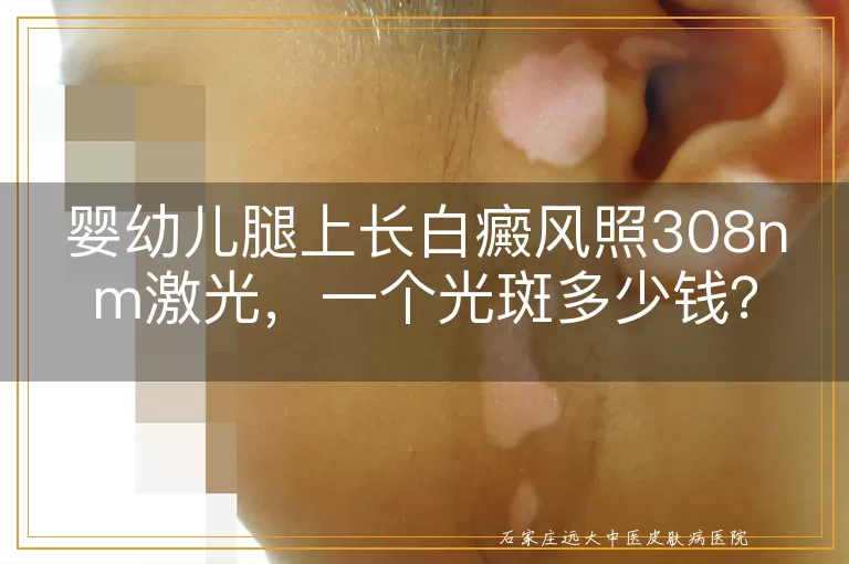 婴幼儿腿上长白癜风照308nm激光，一个光斑多少钱？