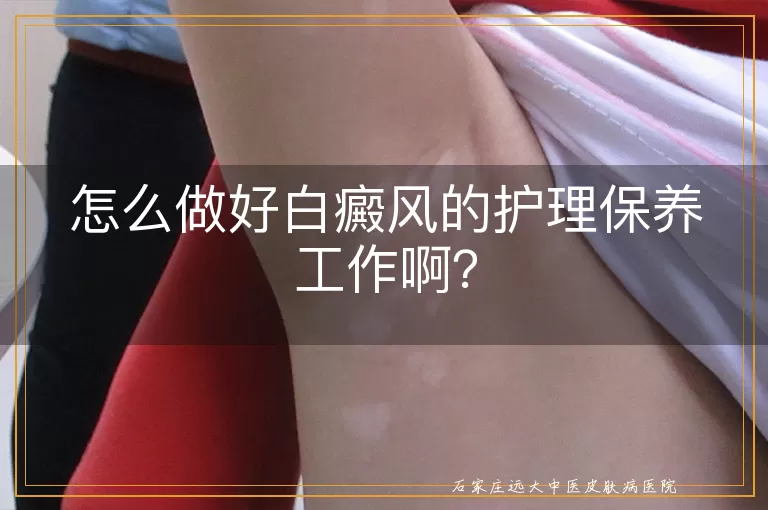 怎么做好白癜风的护理保养工作啊？