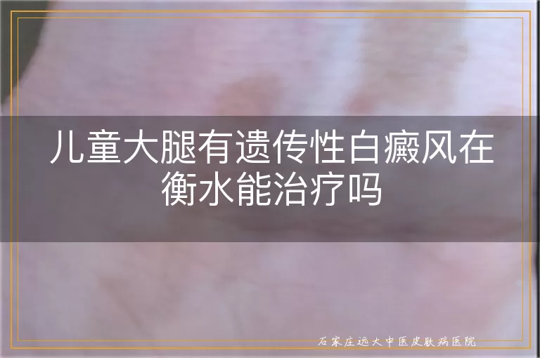 儿童大腿有遗传性白癜风在衡水能治疗吗