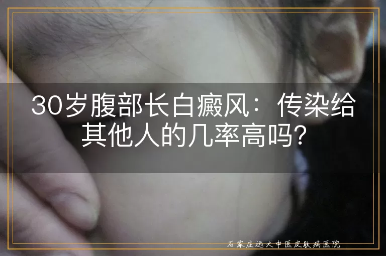30岁腹部长白癜风：传染给其他人的几率高吗？