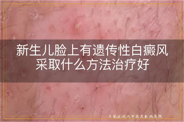 新生儿脸上有遗传性白癜风采取什么方法治疗好