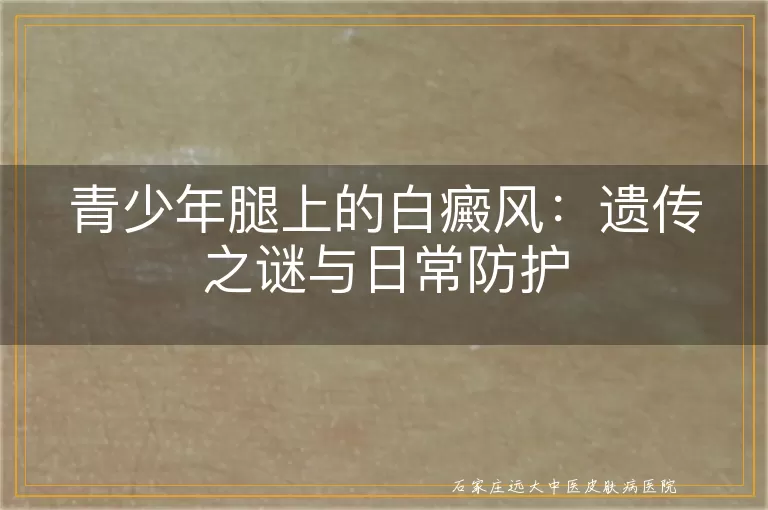 青少年腿上的白癜风：遗传之谜与日常防护