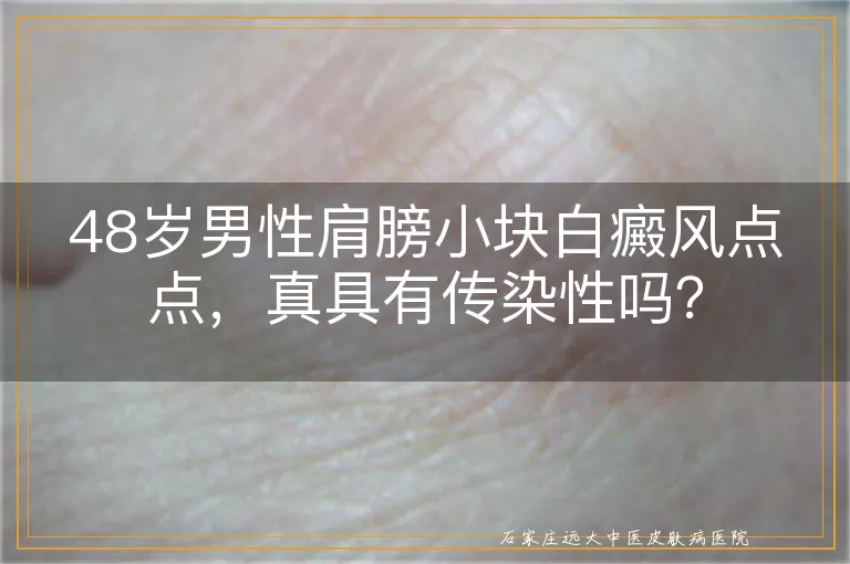 48岁男性肩膀小块白癜风点点，真具有传染性吗？