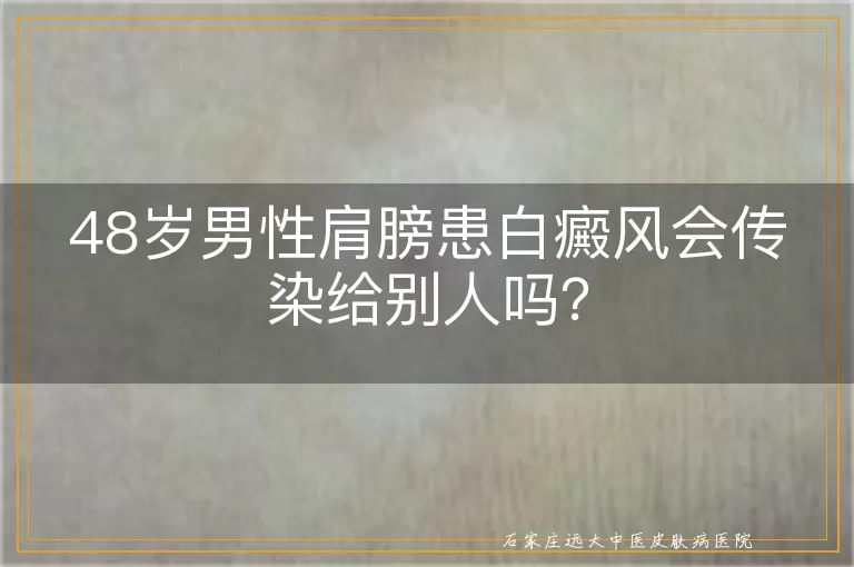 48岁男性肩膀患白癜风会传染给别人吗？