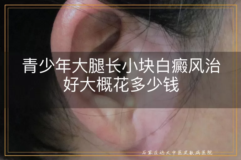青少年大腿长小块白癜风治好大概花多少钱