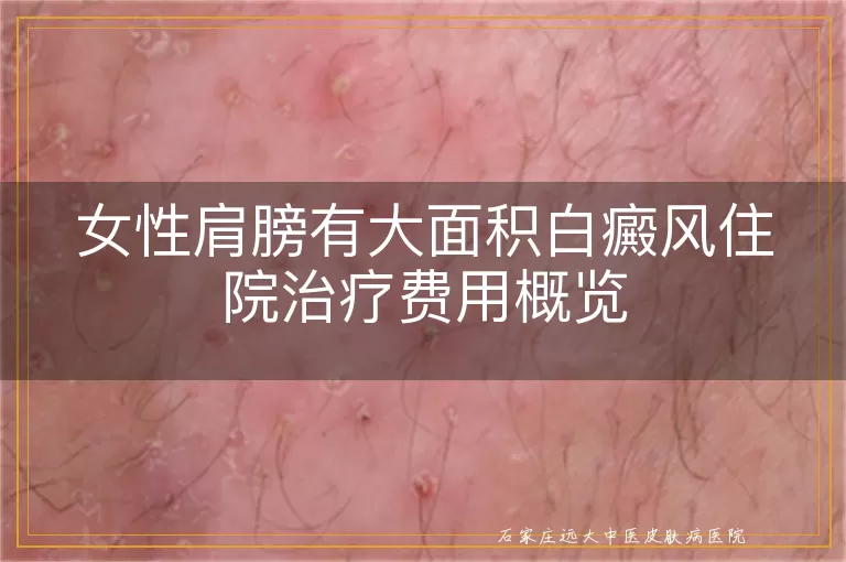 女性肩膀有大面积白癜风住院治疗费用概览