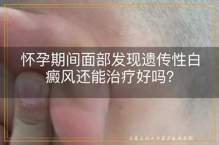 怀孕期间面部发现遗传性白癜风还能治疗好吗？