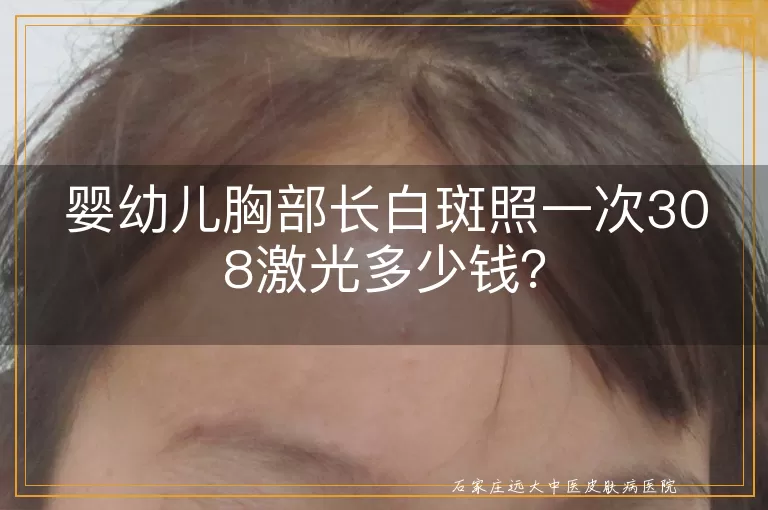 婴幼儿胸部长白斑照一次308激光多少钱？