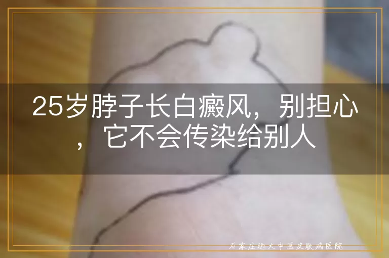 25岁脖子长白癜风，别担心，它不会传染给别人