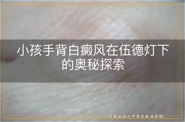 小孩手背白癜风在伍德灯下的奥秘探索