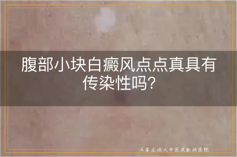 腹部小块白癜风点点真具有传染性吗？