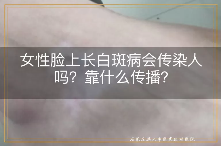 女性脸上长白斑病会传染人吗？靠什么传播？