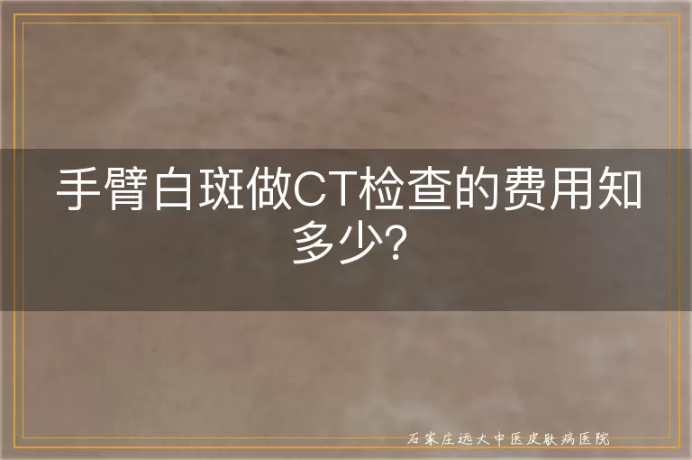手臂白斑做CT检查的费用知多少？