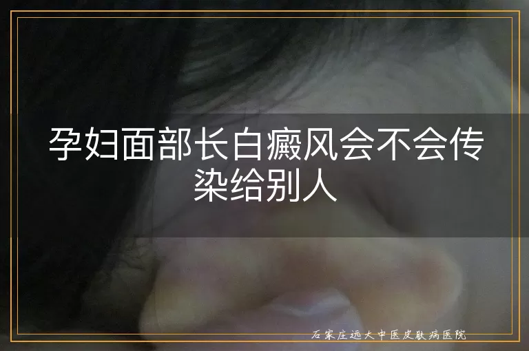 孕妇面部长白癜风会不会传染给别人