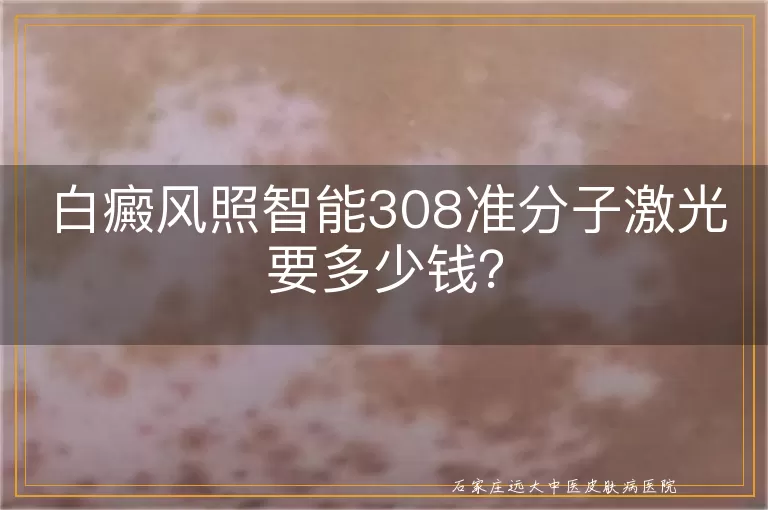 白癜风照智能308准分子激光要多少钱？