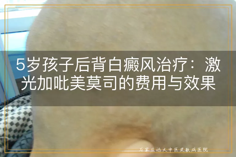 5岁孩子后背白癜风治疗：激光加吡美莫司的费用与效果