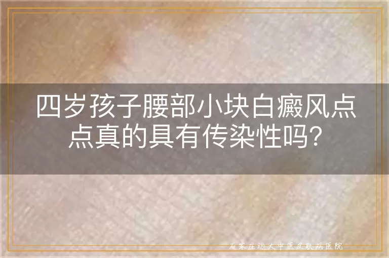 四岁孩子腰部小块白癜风点点真的具有传染性吗？