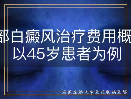 腰部白癜风治疗费用概览：以45岁患者为例