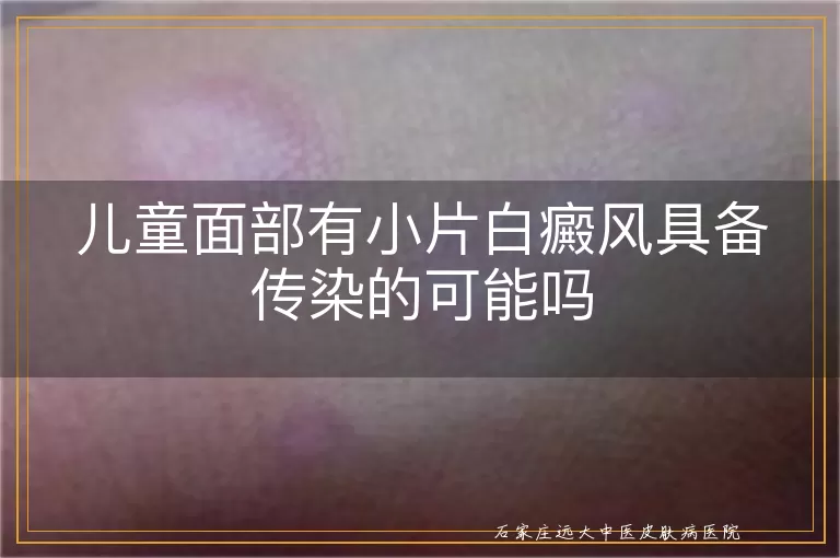 儿童面部有小片白癜风具备传染的可能吗