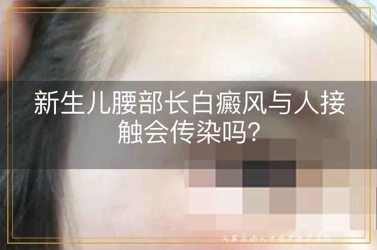 新生儿腰部长白癜风与人接触会传染吗？