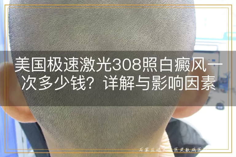 美国极速激光308照白癜风一次多少钱？详解与影响因素