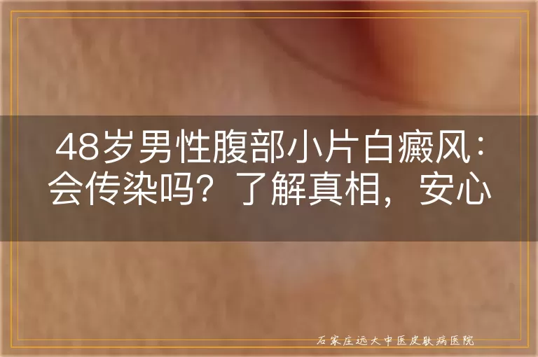 48岁男性腹部小片白癜风：会传染吗？了解真相，安心面对