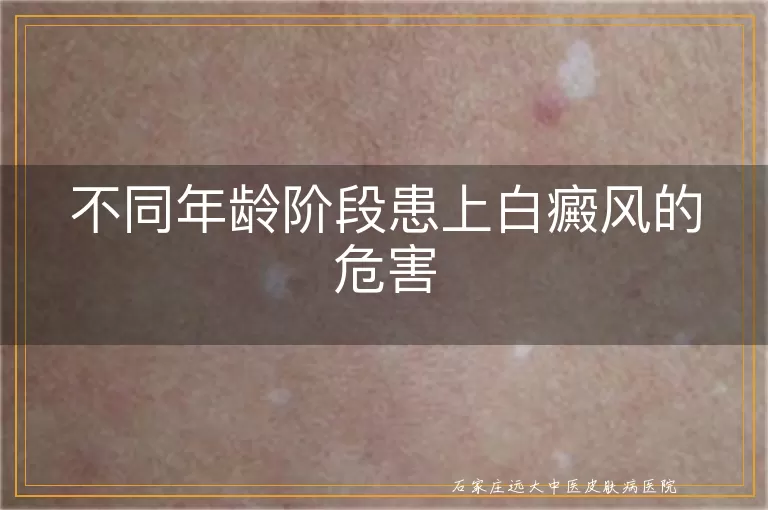 不同年龄阶段患上白癜风的危害