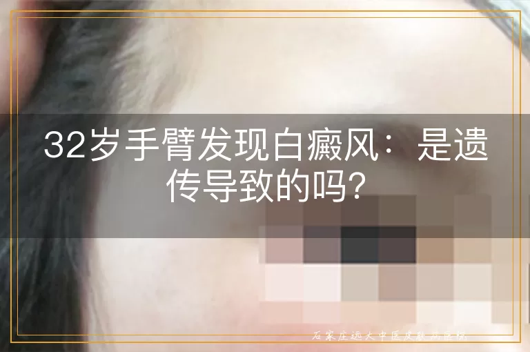 32岁手臂发现白癜风：是遗传导致的吗？