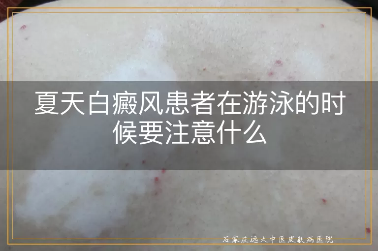 夏天白癜风患者在游泳的时候要注意什么