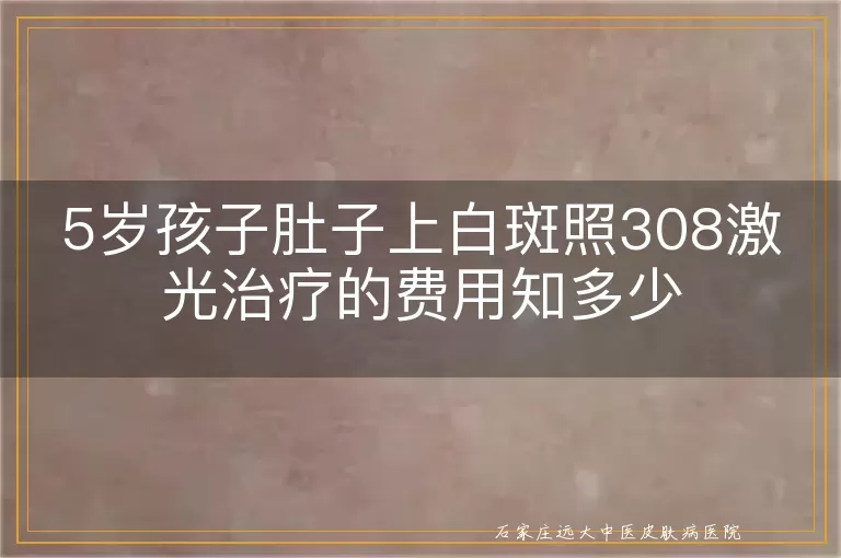 5岁孩子肚子上白斑照308激光治疗的费用知多少