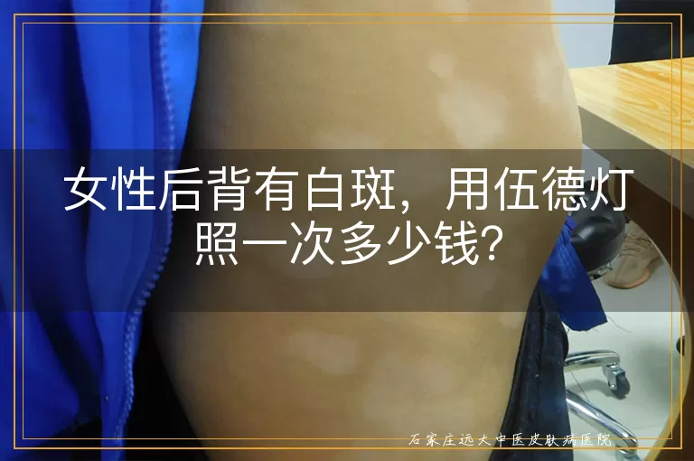 女性后背有白斑，用伍德灯照一次多少钱？