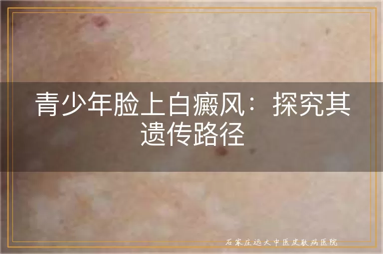 青少年脸上白癜风：探究其遗传路径