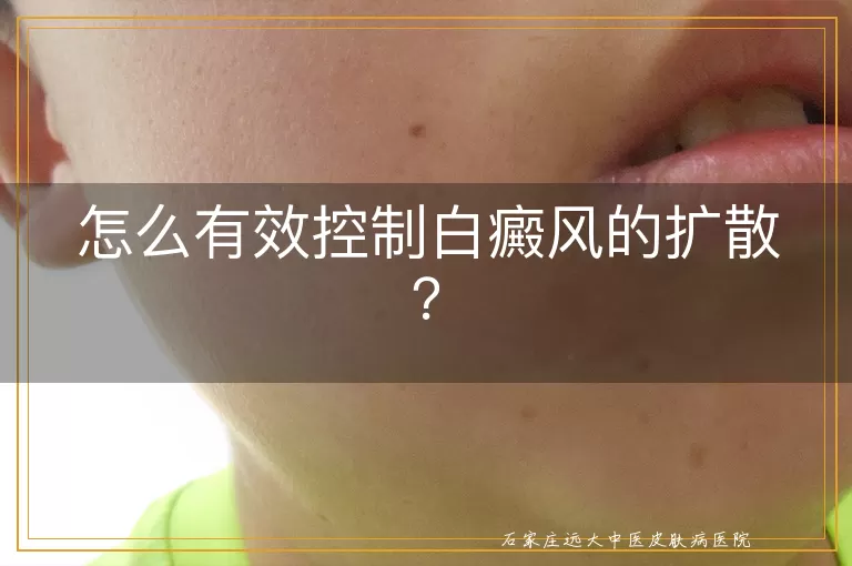 怎么有效控制白癜风的扩散？