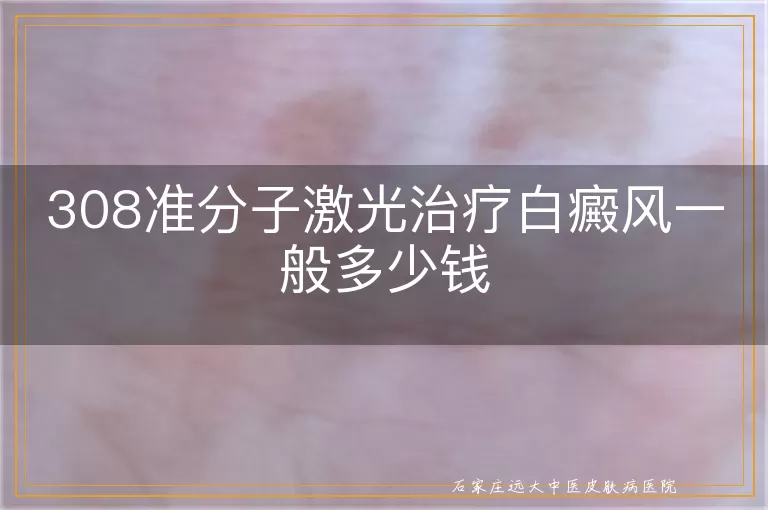 308准分子激光治疗白癜风一般多少钱