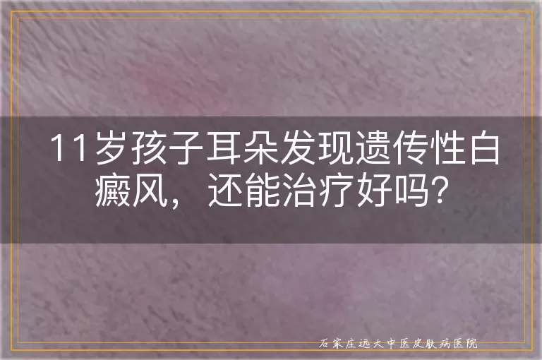 11岁孩子耳朵发现遗传性白癜风，还能治疗好吗？