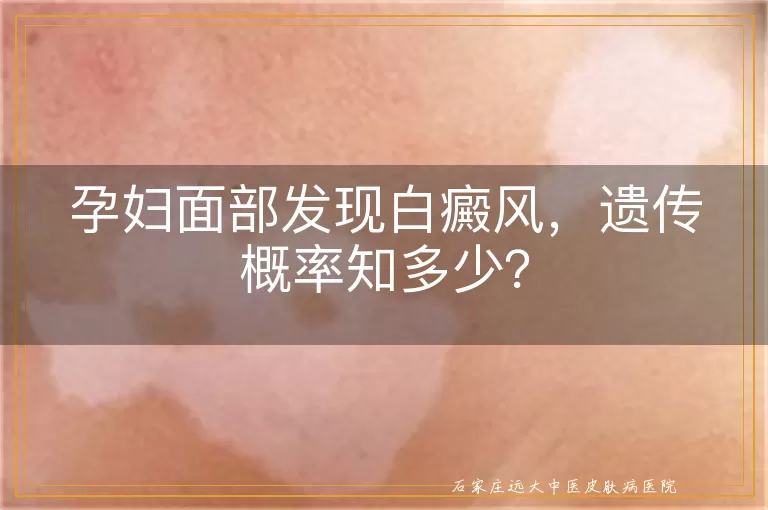 孕妇面部发现白癜风，遗传概率知多少？