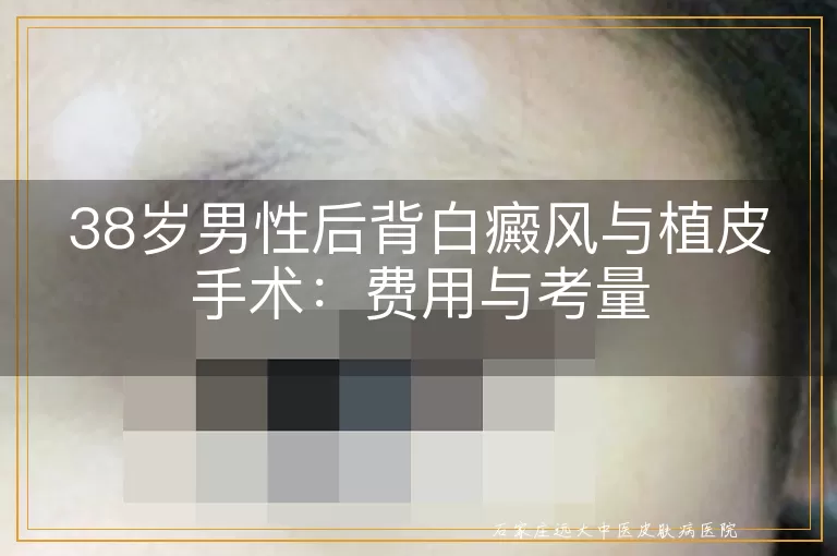38岁男性后背白癜风与植皮手术：费用与考量