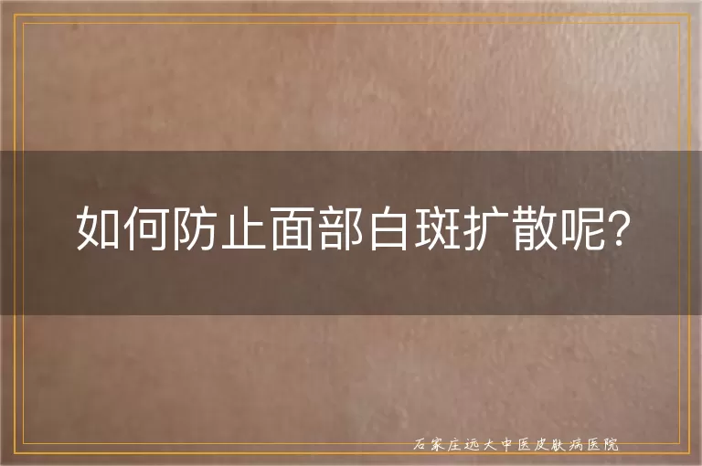 如何防止面部白斑扩散呢？